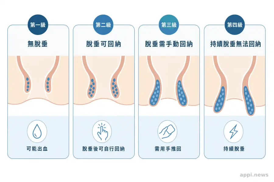 痔瘡症狀分級示意圖，從第一級到第四級的脫垂程度