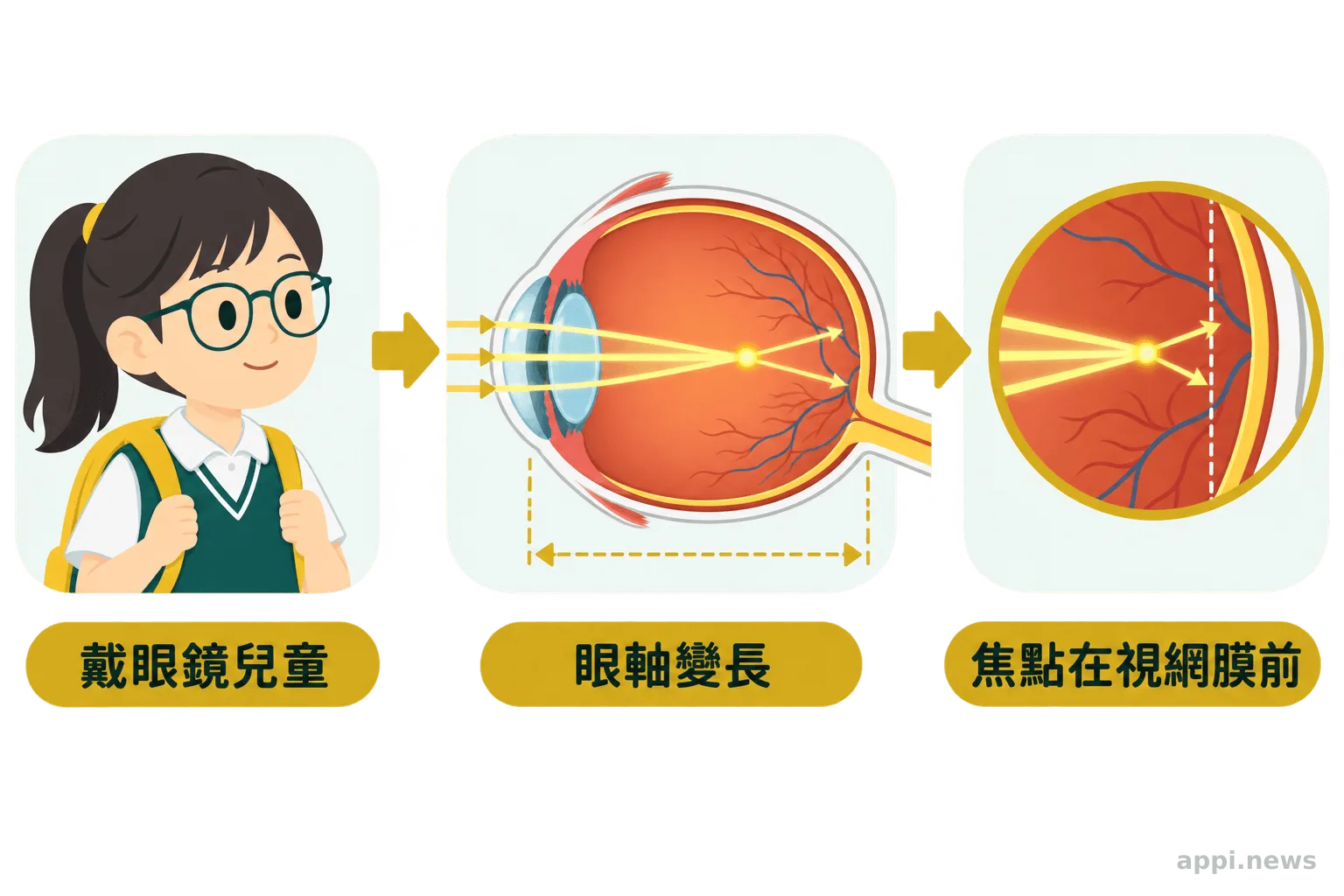 兒童戴眼鏡與近視眼球光線聚焦位置示意圖