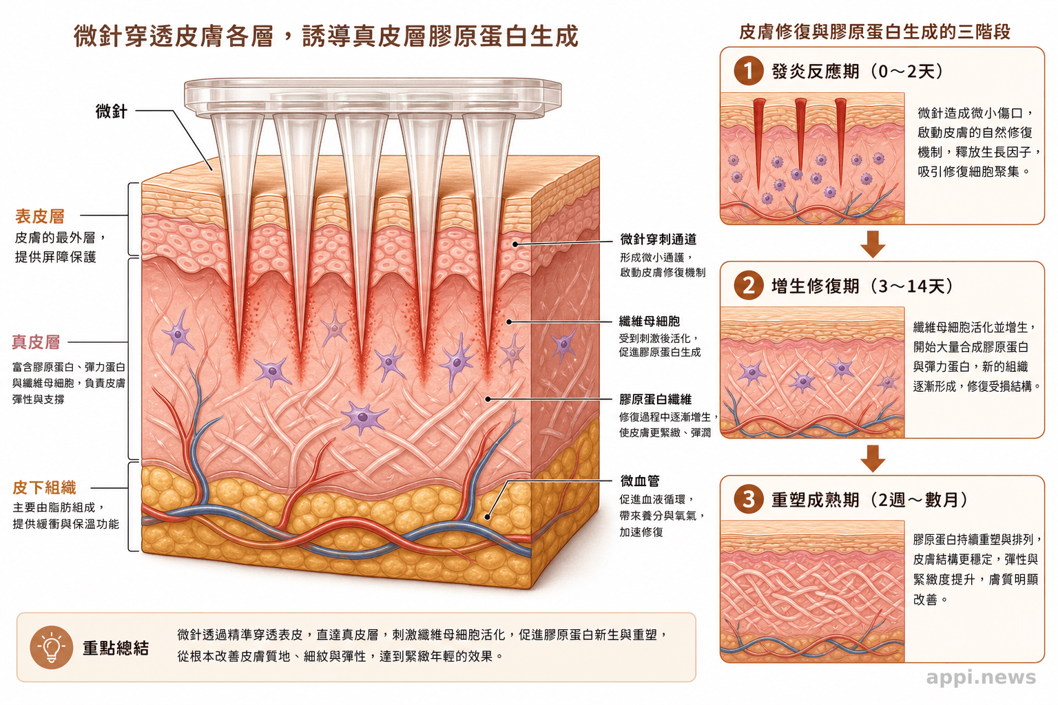 微針穿透皮膚各層、誘導真皮層膠原蛋白生成的截面示意圖