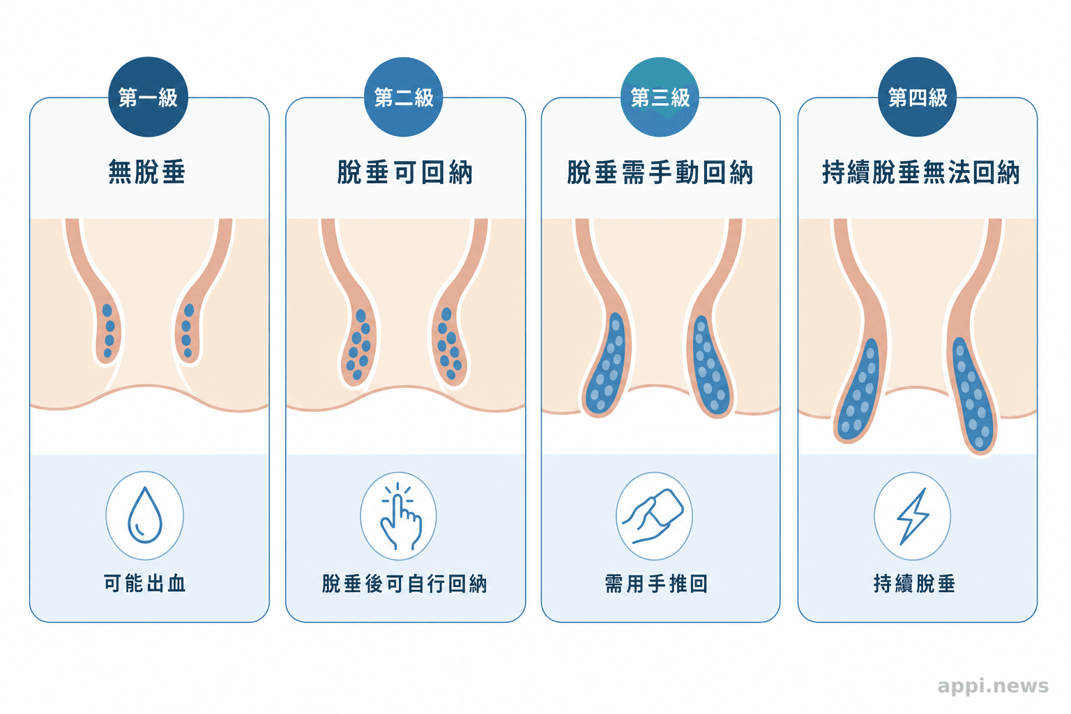 痔瘡症狀分級示意圖，從第一級到第四級的脫垂程度