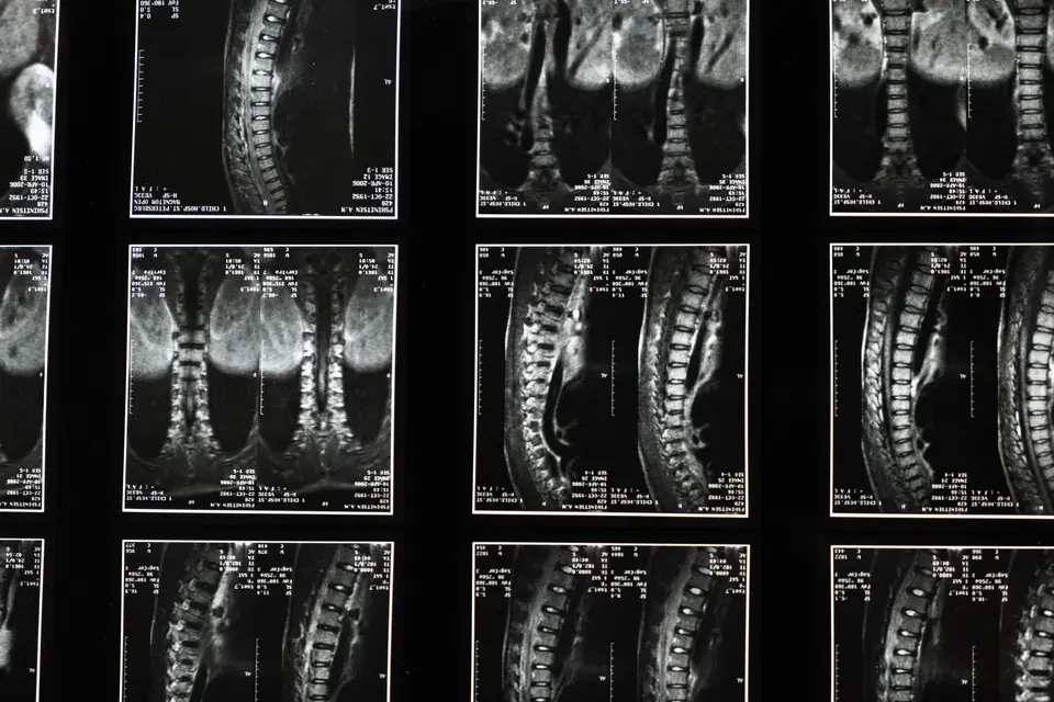 放射科工作站的腰椎 MRI 影像、骨折風險評估資料與紅色警示標記