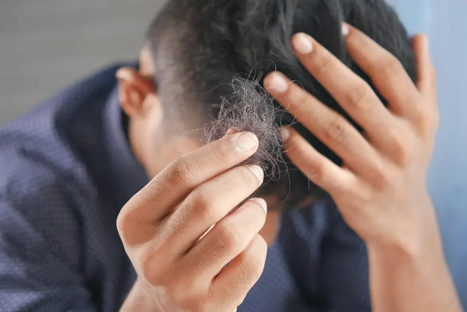 一名男性雙手捧著從頭頂脫落的一束頭髮,頭部微低