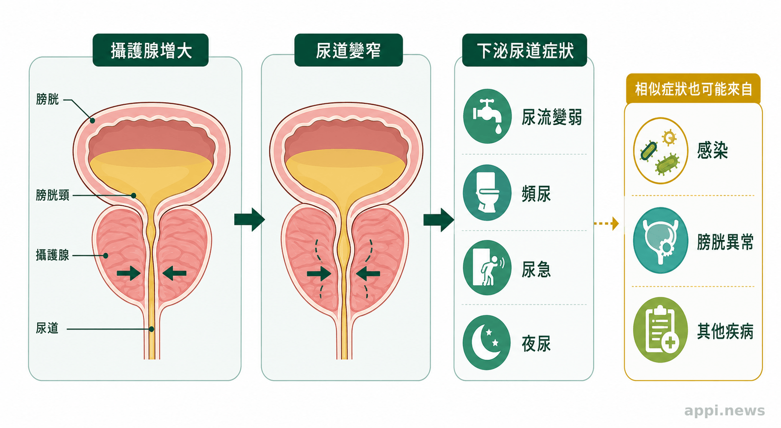 膀胱下方的攝護腺增大並壓迫尿道,旁邊標示尿流變弱、頻尿與夜尿等症狀