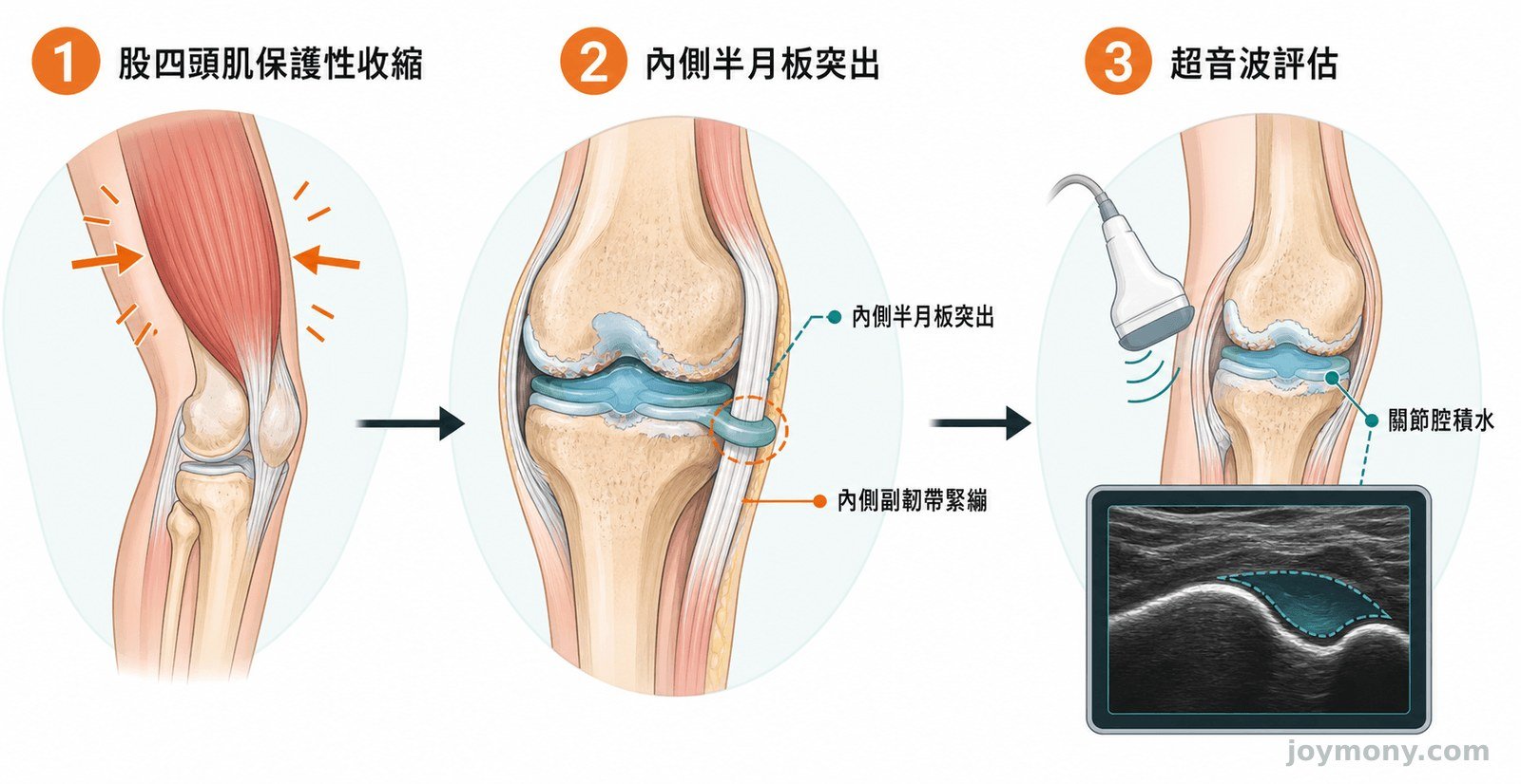 膝蓋腫痛五項分流訊號示意，包括外傷、時間、承重、紅熱與卡住
