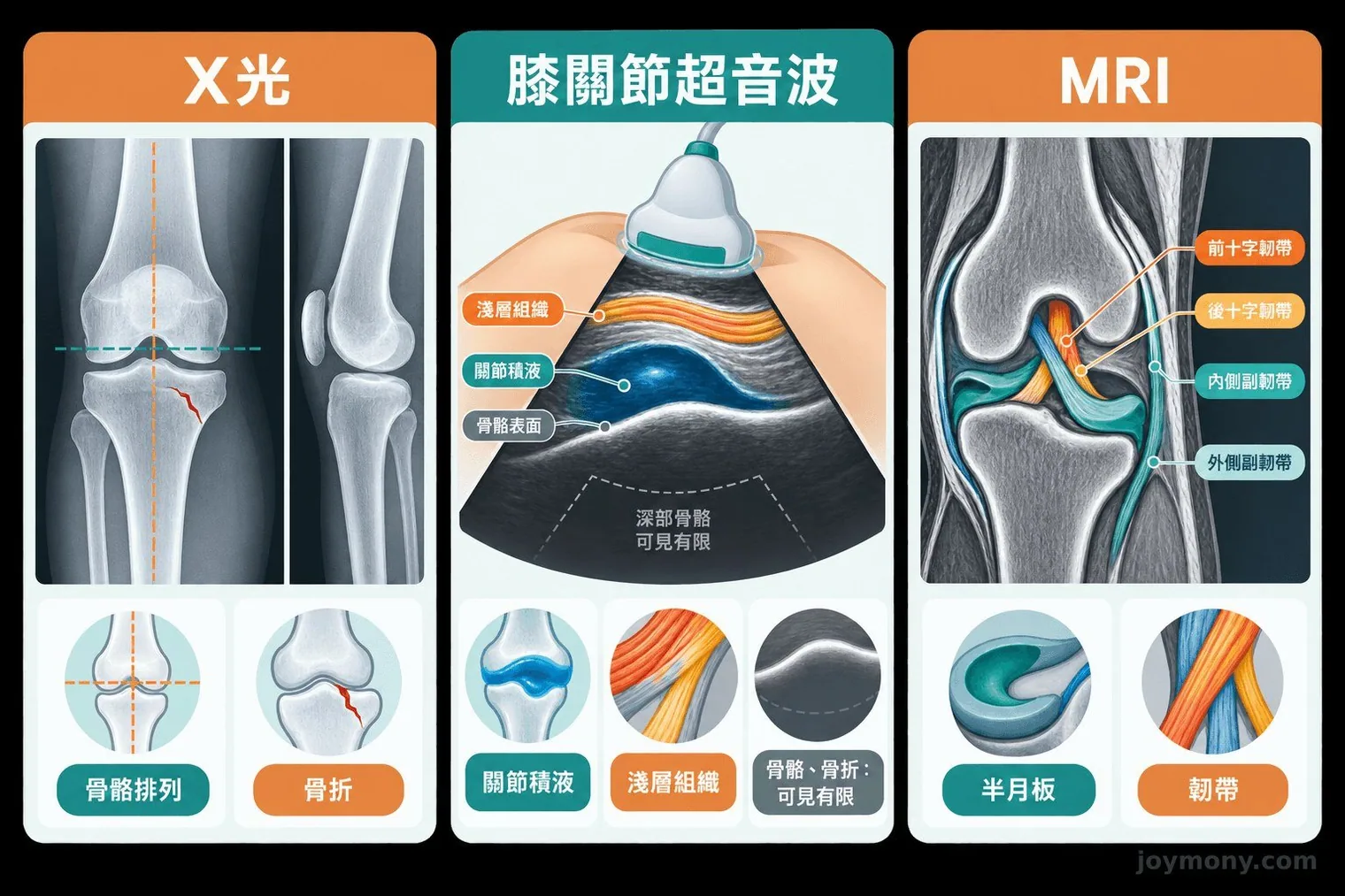 X 光、膝關節超音波與 MRI 可評估範圍比較